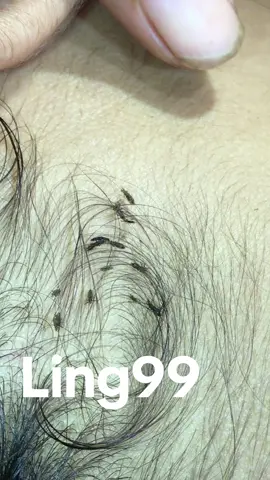 Remove lice #omg😘😘😘😍😍😻😻😽😽🥳🥳😂😂😂 #liceremoval #lice 