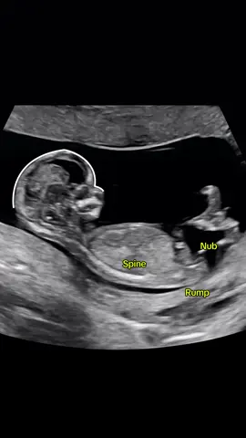 He or She? The link to the gender prediction app is in my profile 🩷💙 #momtobe #heorshe #pregnancy #nubxapp