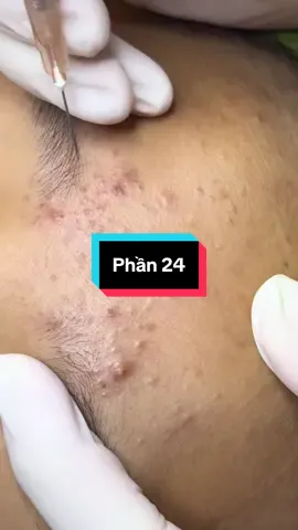 Đăng video khui đầu mụn mà flop là từ nay tui nghỉ khui đầu mụn nha mấy ní #mụn_ẩn #xuhuongtiktok #trimunthuduc #viral #mụn_viêm 