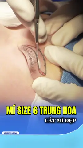 Chưa bao giờ hối hận khi CẮT MÍ 😊 #hangnhungeva #phauthuatthammy #viral #catmi  #beauty 