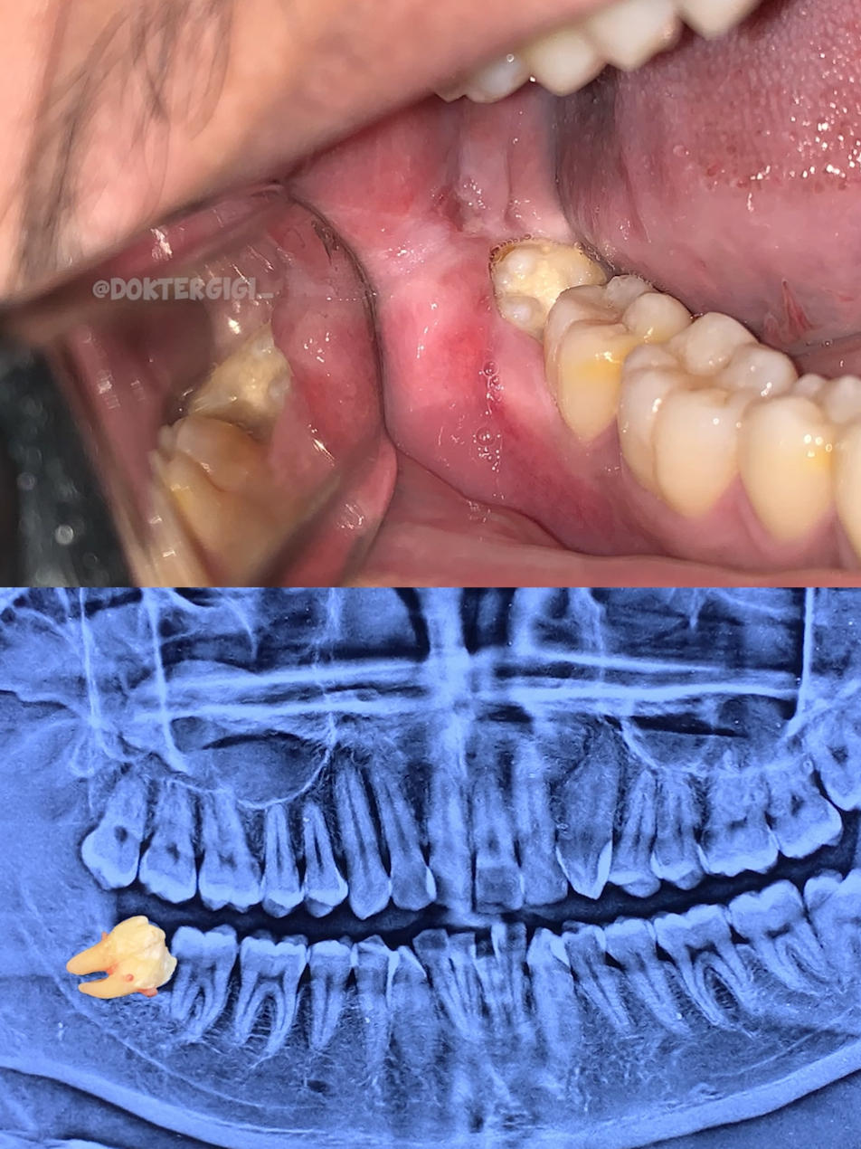 Odontectomy. #doktergigijakarta #doktergigimakassar #doktergigimedan #doktergigibekasi 