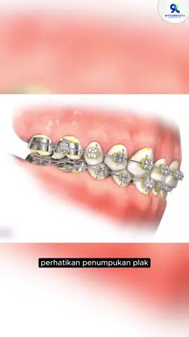 🦷 Pakai Behel? Menyikat Gigi Jangan Asal-asalan! Pakai behel bukan berarti bebas sikat asal bersih. Kalau salah cara, plak bisa menumpuk, gusi bisa bengkak, bahkan gigi bisa berlubang meski sedang ortho 😬 Makanya, penting banget tahu cara menyikat gigi yang benar untuk pengguna behel: ✅ Sudut sikat 45° ke arah kawat ✅ Gerakkan perlahan, fokus ke sela-sela behel ✅ Jangan lupa pakai sikat khusus ortho & interdental brush ✅ Sikat lidah juga ya biar napas tetap segar 🦷 Ingin tahu lebih jelas gimana gerakannya? 🎥 Selengkapnya yukkk simak video edukasi animasi gosok Gigi bagi pengguna behel sampai selesai yaa! Bagi Sobat NineC yang mau Pasang braces atau mau konsultasi terlebih dahulu bisa Langsung Hubungi Mincy di 📲 Wa: 0819 9915 2154 Atau bisa DM Mincy di @9corthodontics yaa ☺ Mincy tunggu ☺ 