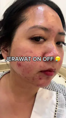 Jerawat bisa reda dengan YOU AcnePlus Moist, bikin kulit tetap tenang dan lembap 🤫 #jeratjerawat #skincare #fyp #foryou #foryoupage  