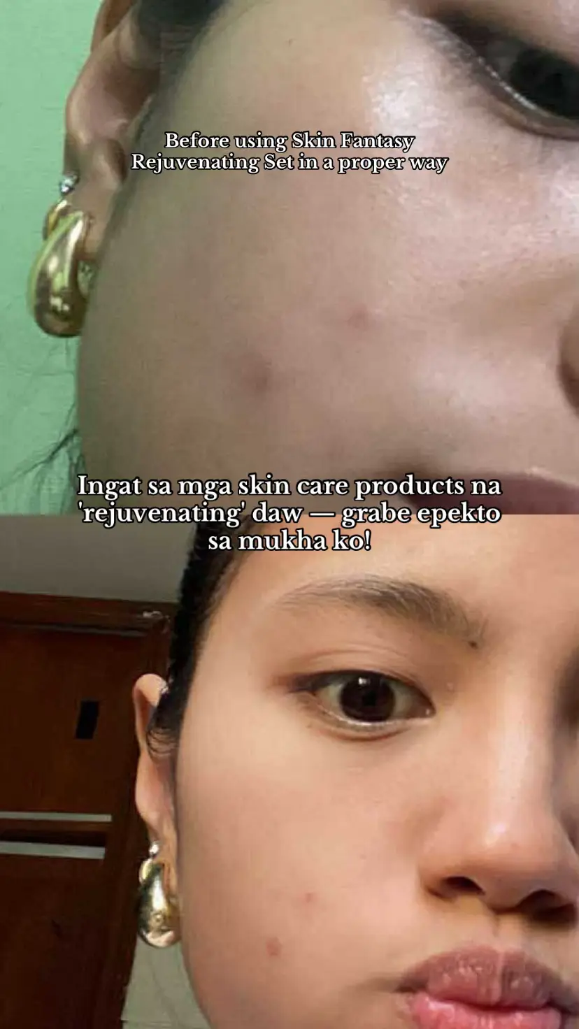 Gamitin nyo na toh! Para sa mas clearer na skin! #SkinFantasy #RejuvenatingSet #Sunscreen #acnetreatment #acnesolution 
