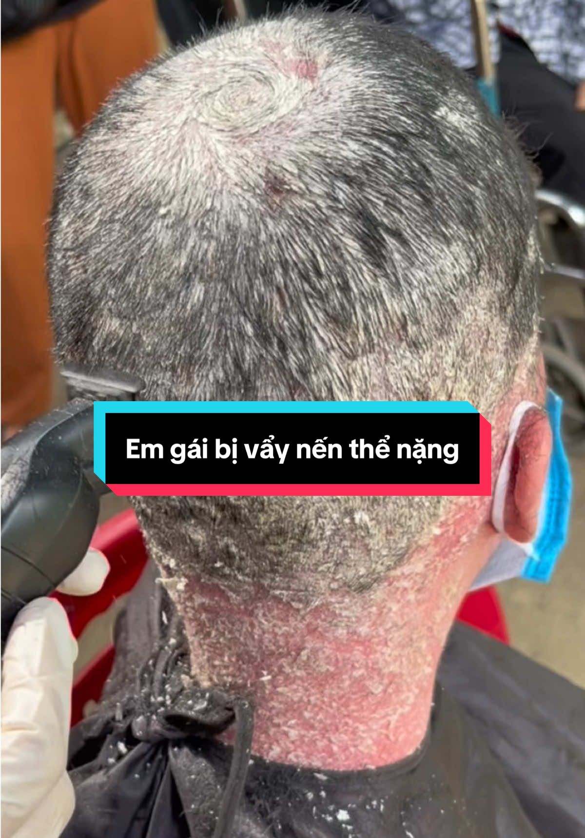 Em gái bị vẩy nến thể nặng ngày đầu đến nhà cô tuyến uống lá tắm lá#vaynen #viemdacodia @Thị tuyến dc 35 