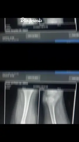 #Interventional #Radiological #Technologist #orthopaedicsurgery ##dontunderreviewmyvideo  @Sayed Nizam Jan Termize @Dr Sahibzada Imtiaz Ahmad 