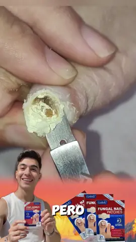 Ugly Toenails? Fungus Problems? Fix Them INSTANTLY with These Magic Nail Stickers! + Get Healthy & Beautiful Toes NOW! #footcare #nail #toe #toes #nailtok 