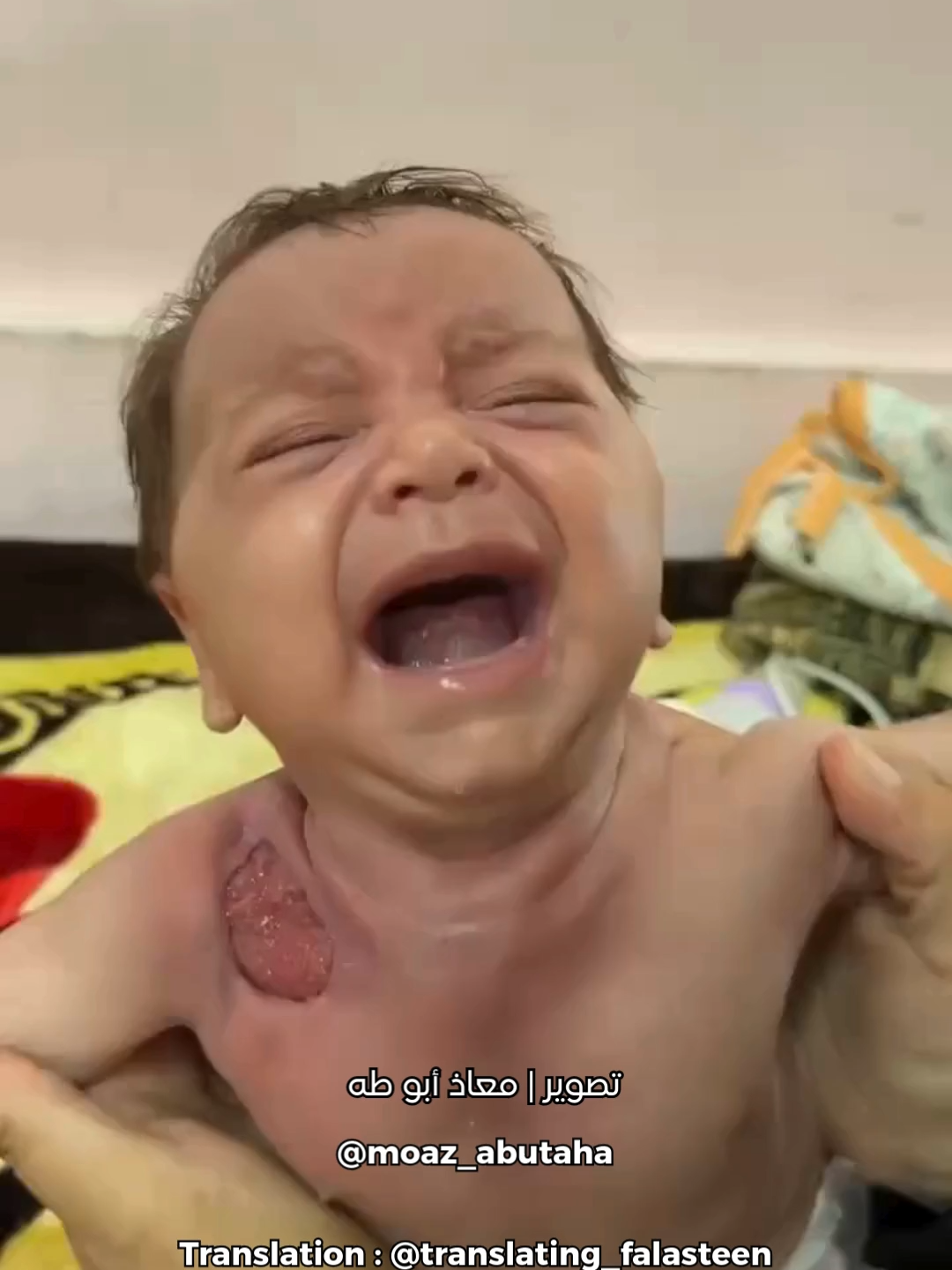 Three-month-old Salma Kamal Ali Qwaider is currently lying in a hospital bed at Nasser Hospital (Al-Tahrir), suffering from a severe immune deficiency and painful skin infections. Her wounds do not heal, and she has developed mouth ulcers due to her weakened immune system. Her condition is deteriorating day by day. Her mother says Salma cries constantly and is in visible pain, made worse by the harsh living conditions in displacement tents. Doctors can only offer basic antibiotics, but her recovery is impossible without advanced treatment abroad. The family is pleading for urgent medical evacuation. To contact the family: 00970599909316 الطفلة سلمى كمال علي قويدر، تبلغ من العمر ثلاثة أشهر، ترقد الآن في مستشفى ناصر (التحرير) وتعاني من نقص حاد في المناعة والتهابات جلدية شديدة. جروحها لا تلتئم وتُعاني من تقرحات في الفم نتيجة ضعف المناعة. حالتها تسوء يومًا بعد يوم، ولا تتوقف عن البكاء من شدة الألم، خاصة في ظل الظروف الصعبة داخل الخيام. الأطباء يقدمون لها مضادات حيوية فقط لتثبيت وضعها مؤقتًا، لكن علاجها الكامل غير ممكن داخل غزة. العائلة تناشد بسرعة تسفيرها لتلقي العلاج خارج القطاع. للتواصل مع العائلة: 00970599909316 Source: @moazabutaha  Translation: @translating_falasteen