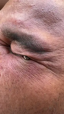 Omg #ticks #tickshot #ohmygod #tickseason #ticksonhand 