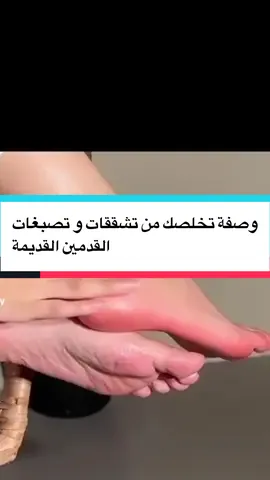 وصفة تخلصك من تصبغات القدمين و تشققات القديمة#وصفات #ماسكات_طبيعية #foryoupage❤️❤️ #france🇫🇷 #الشعب_الصيني_ماله_حل😂😂 