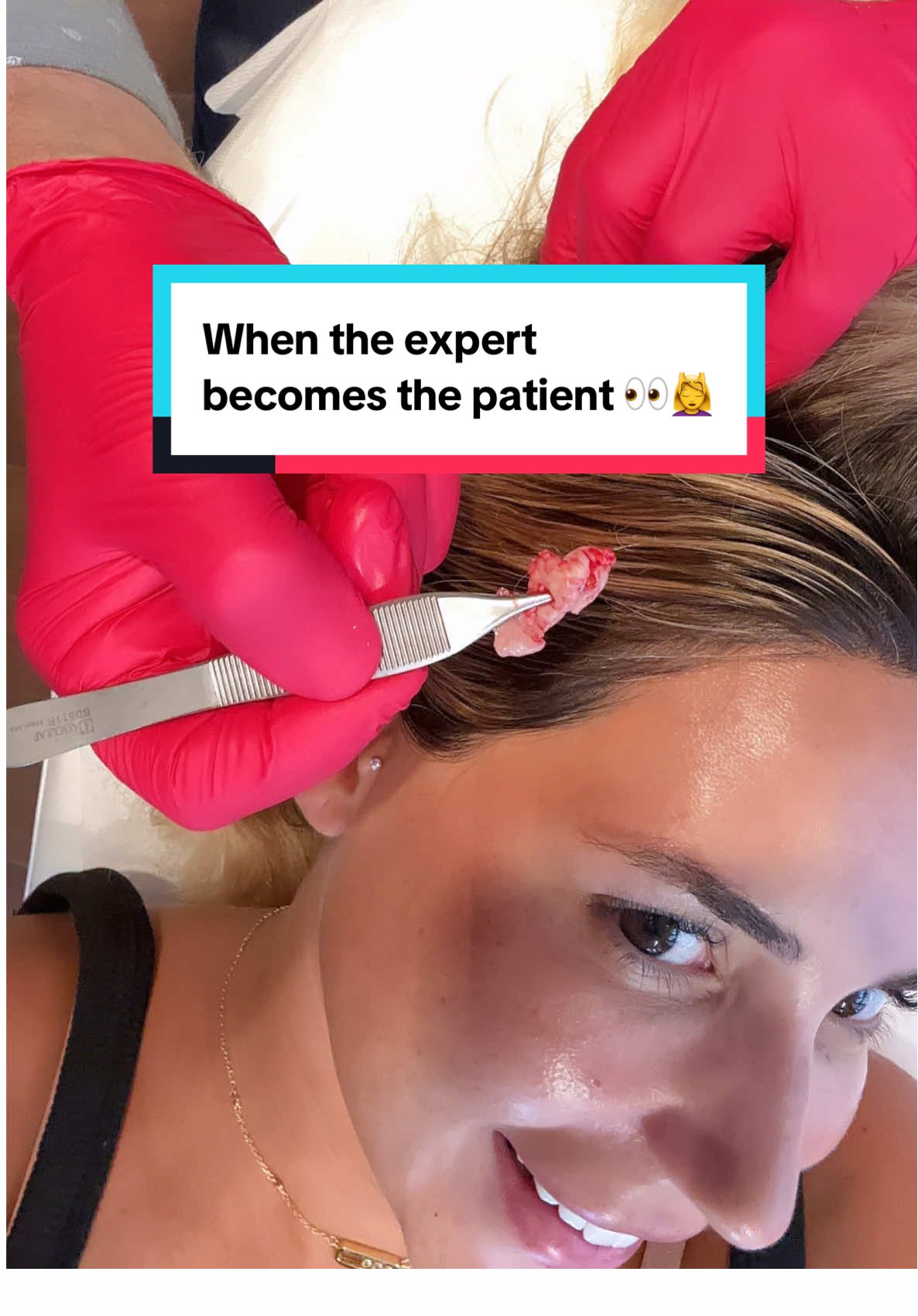Can’t pop my own problems… so I found backup 😉 follow for more IG @Ekbeautyclinic.be #pimple #pop #more #satisfyingvideo #warning⚠️ 