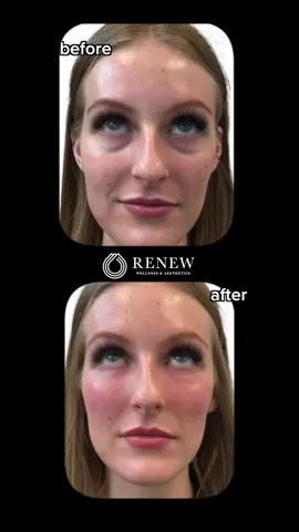 Serving face… and neck… and actually everything 💅 #renewoklahoma #aesthetics #GlowUp #transformation #plasticsurgery 