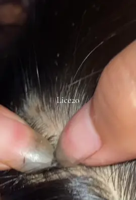 😱😱😱😱#omg #lice #liceremoval 
