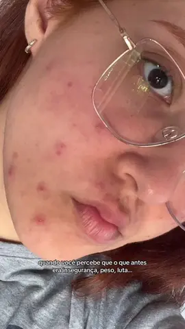 Nada me deixa mais feliz do que saber que to ajudando alguém🥹 Se eu consegui, vocês também conseguem!!!! 💖 #foryouuu #fourpage #skincare #acneskin #juntos 