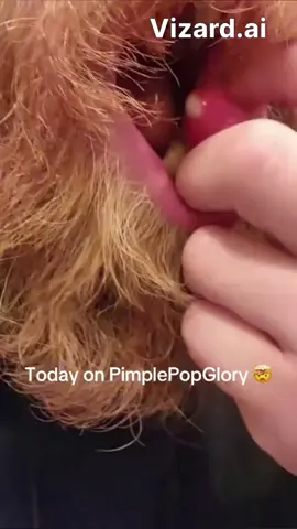 Get ready to dive into the fascinating world of personal care with this captivating content! Witness the meticulous art of grooming as a hand gently interacts with the skin, addressing an irritable red bump—perfect for all the pimple-popping enthusiasts out there! 💥✨ The careful approach and bright lighting highlight every detail, drawing you in with a sense of intimacy and precision. But that's not all! Marvel at the grooming of a luscious, reddish-brown beard as it receives the attention it deserves. Enjoy the soothing visuals of deliberate hand movements, showcasing the care and effort that goes into personal grooming. Plus, the experience of eating, with a focus on the delightful peeling of a juicy fruit, adds an intriguing sensory layer to the mix. 🍌😋 Catch the playful vibe and enjoy this close-up action that celebrates personal care routines in all their glory! #PimplePop #GroomingGoals #BeardCare #FoodieFun #PimplePopper #CloseUpMagic #SelfCare #SkincareRoutine #SatisfyingVideos #VizardAI