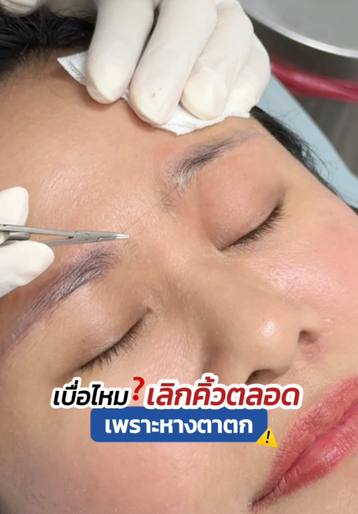 เลิกคิ้ว หนักตาตลอด‼️ เพราะหางตาตก 🥹 แก้ด้วย #subbrowlift #ซ่อนแผลใต้คิ้ว #skyclinic #ทีมแพทย์หมอสกาย #ศัลยกรรมตา 