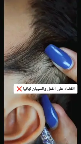 وصفة طبيعية للتخلص من القمل والسيبان نهائيا ❌️ #القمل #علاج_طبيعي #وصفة #foryoupage #قمل 
