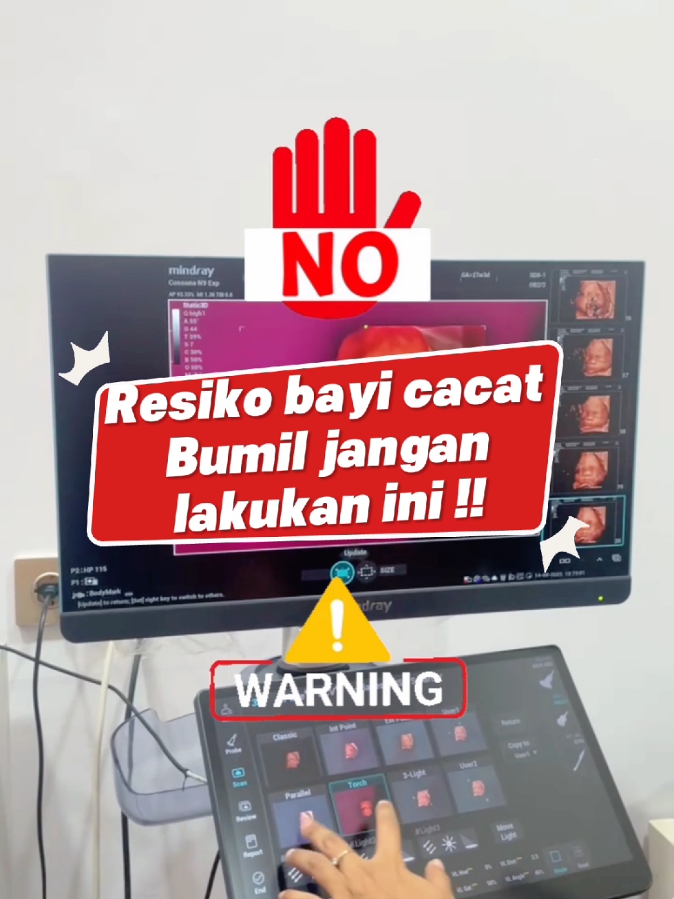 *Wajib Tahu! 4 Hal yang Berisiko Membuat Bayi Cacat 🤰🏻🚨* Sebagai ibu hamil, penting untuk menjaga kesehatan dan keselamatan janin. Berikut 4 hal yang wajib dihindari untuk mencegah risiko bayi cacat: 1. *Konsumsi Obat Sembarangan 💊*: Jangan mengonsumsi obat tanpa resep dokter, karena dapat membahayakan janin. 2. *Sering Konsumsi Alkohol dan Kopi 🍺☕️*: Alkohol dan kafein dapat meningkatkan risiko cacat lahir dan gangguan perkembangan janin. 3. *Merokok 🚭*: Merokok dapat meningkatkan risiko cacat lahir, kelahiran prematur, dan gangguan kesehatan lainnya pada janin. 4. *Makan Sembarangan 🍔🥤*: Jangan mengonsumsi makanan yang tidak seimbang atau mengandung bahan berbahaya, karena dapat membahayakan janin. *Jaga Kesehatan Janinmu, Hindari 4 Hal Ini! 🌟* Bagikan informasi ini dengan teman-temanmu yang sedang hamil, agar mereka juga dapat menjaga kesehatan janinnya! 🤰🏻💕 #IbuHamil #KesehatanJanin #CacatLahir #Hindari4HalIni  Sayangi dirimu, lindungi si kecil sejak dini 🤰❤️ #USG5D #KonsultasiGratis #BayiDalamKandungan 