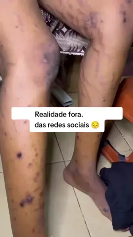 #estrias #pelesaudavel #foryoupage❤️❤️ #pele  Não tapa com Roupas não vive de Aparência  se trata! 🥺