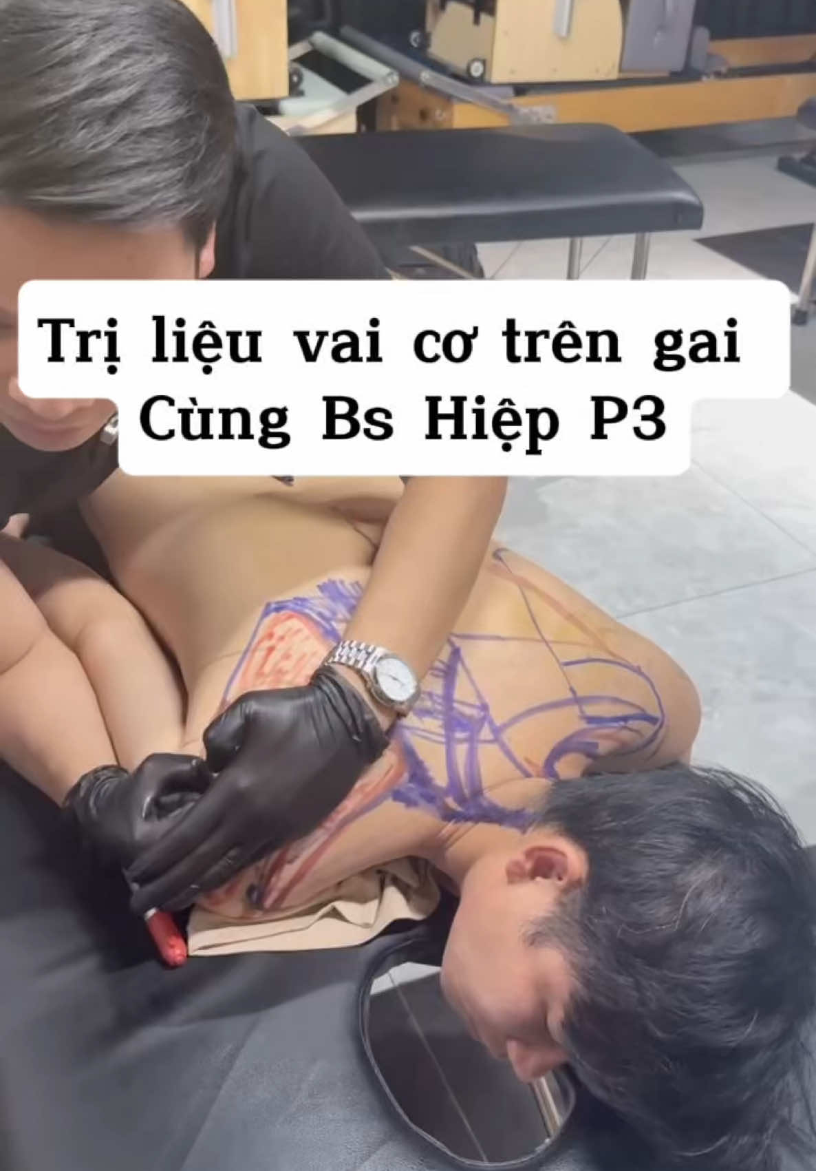 Trị liệu vai gân cơ trên gai P3 cùng Bs Hiệp #căngcơ #pickleball #xuhuong #pickleball #hoctrilieu #bacsitrilieu #đôngcứngkhớpvai #itbandsyndrome #đaucổvaigáy #đauvai #thoátvịđĩađệm #chấnthương 
