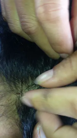 #lice #fyp #viral 