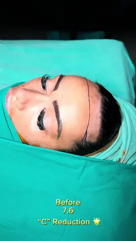 Forehead reduction with the C Reduction technique “Confidence-boosting transformation! ✨ We our forehead aesthetic surgery, and the results are fantastic! 🙌🔥  • #ForeheadReduction #ForeheadReductionSurgery #HairlineLowering #HairlineSurgery #ForeheadReductionBeforeAndAfter                   