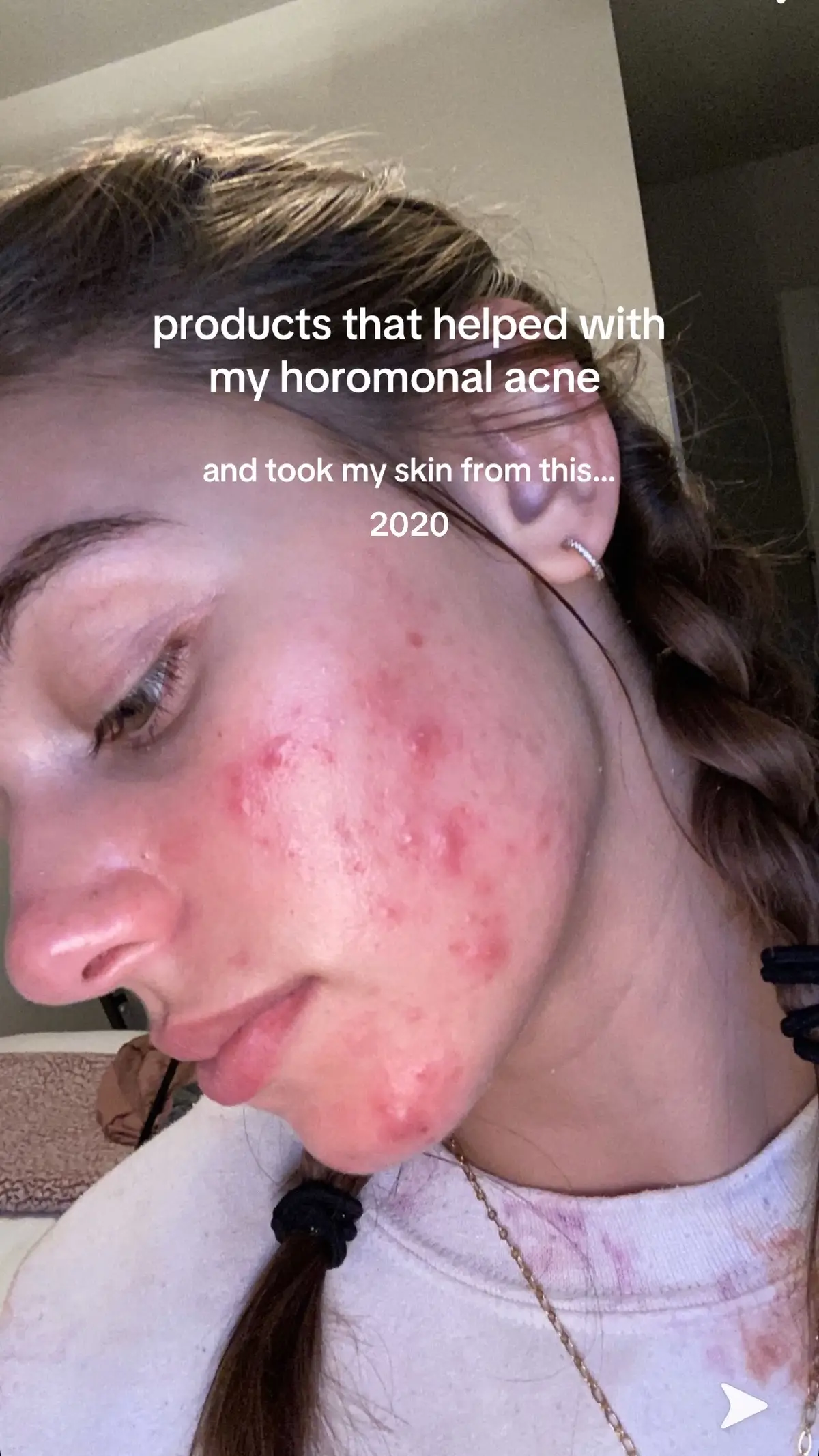 reminiscing on how far I’ve come with my skin 🥹I remember at the start of my acne journey, I’d spend hours and hours on YouTube watching girls with perfect skin share their skincare routines, thinking if I used the products they swore by then my skin would magically look like theirs (spoiler: it only made my acne 10x worse) and I literally had no idea what I was even putting on my face lol (and now realizing so many of them were sponsored but I didn’t realize or understand what that meant)  i’m so thankful TikTok existed during this time because it’s where I was able to find creators who were actually educating (like @Charlotte Palermino ) breaking down ingredients, explaining how products really work, and reminding us that sometimes less is more. And that’s when I found the products that worked for me and my skin finally started calming down. thinking about my skincare journey this just makes me so grateful for creators who take the time to thoughtfully educate on this app (they help soo many) and for how much creator transparency has grown in the last 5 years :)