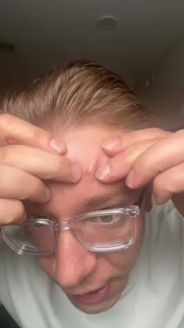 Love pimple patches #pimples #pimple #pimplepatch 