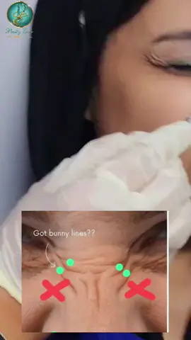 الان مع📢 pretty ever Academy  دبلومه حقن الفيلر والبوتوكس والسكين بوستر  الدبلومه بتكون 4ل5 ايام ✅متاح مكثفه ع يومين ✅متاح اونلاين   (دراسه نظري وعملي ) 🛑دارسه تشريح البشره  والتعرف  عليها  يخص البوتوكس من :  🛑استخداماته التجميلية والعلاجية . 🛑كيفية حقن الوجهه بالكامل والجسم  🛑اهم الاخطاء المرتكبة مع كيفية تصحيحها مع التطبيق العملي . الفيلر :  🛑كيفية التعامل مع المادة . 🛑الاختيار الصحيح للمادة . 🛑الاثار الجانبية . 🛑اخطاء حقن الفيلر و كيفية التعامل معها . 🛑طرق حقن الوجهه بالكامل  باحدث التقنيات مع تطبيق عملي  🛑التعرف على عضلات الوجه.  🛑إجراءات التعقيم المطلوبة لتجنب انتقال العدوى .  ✅كورس شامل شهاده من الاكاديميه معتمده من نقابه المهن الطبيه و الصحيه  تستلميها في نهايه الكورس❤️ ✅ومتاح شهاده الجامعه الامريكيه والكارنيه المعتمد في ١٠٢ دوله بي رسوم  اضافيه 👌🏻 ✅ومتاح شهاده مزاوله تجميل غير جراحى وكارنيه مزاوله تجميل غير جراحى  ✅ومتاح اعتماد دولي من بورد الأمريكى  بدراسه  فيلر  وبوتوكس برسوم اضافيه  للتواصل والحجز  01055792191  #هولندا #البحرين #الكويت🇰🇼  #skin_care_cource   #diploma_botox_filler     