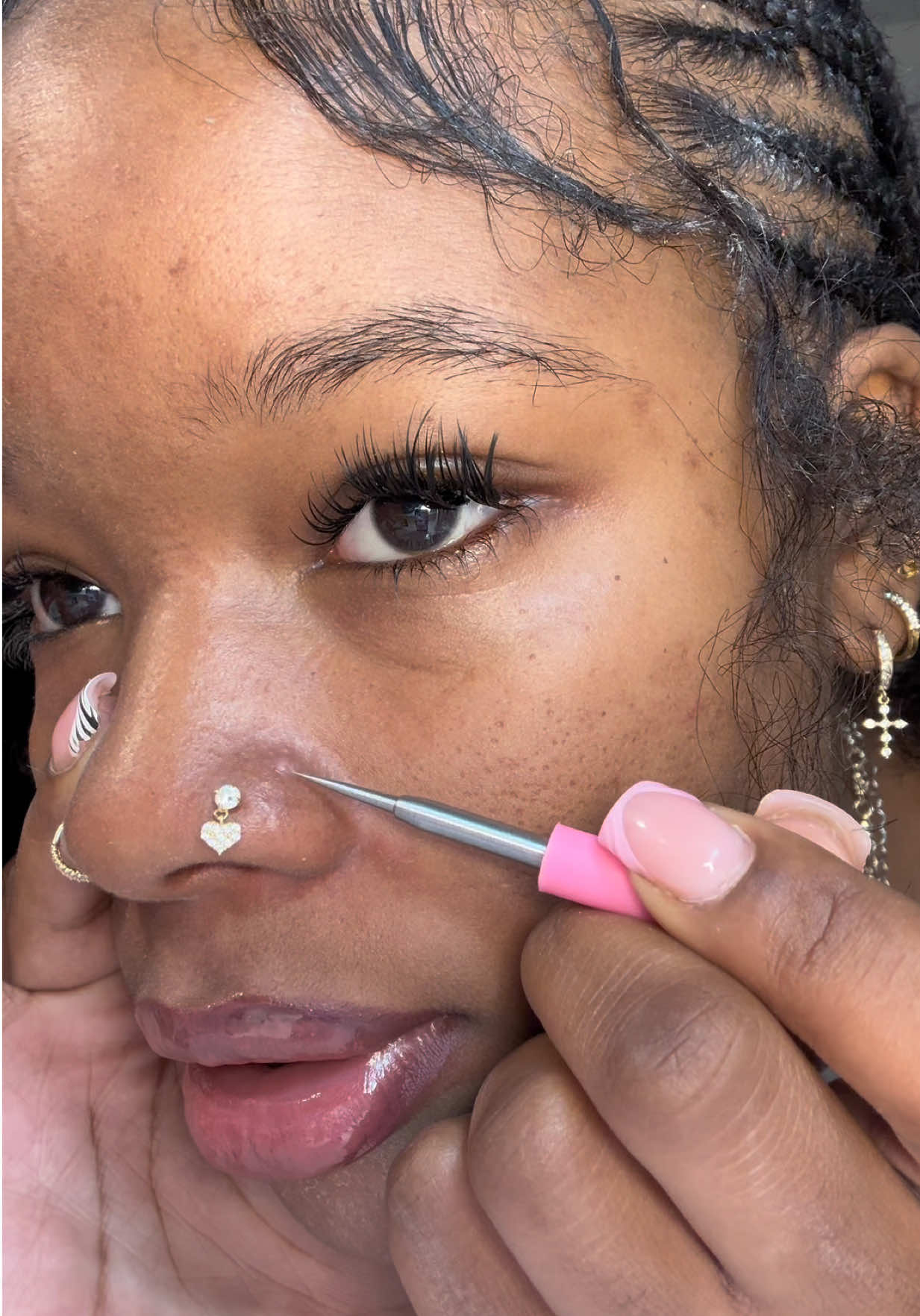 Savor these moments yall 🥹 my skin has clearedd! #acne #satisfying #extractions #fy #skintok 