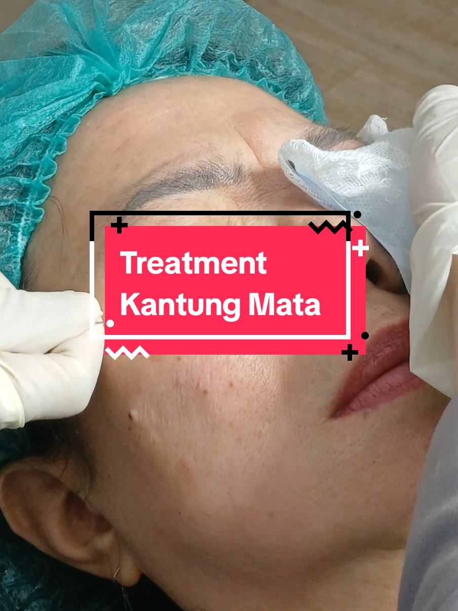 Treatment kantung mata sedang promo sampai Akhir Bulan. minat chat admin : 081112502655 ● FREE KONSUL DOKTER SENIOR ● HASIL PERMANENT ● TINDAKAN 1-2 JAM ● PEMULIHAN 3-7 HARI #fyp #kantungmata #wijayaplatinumtebet 