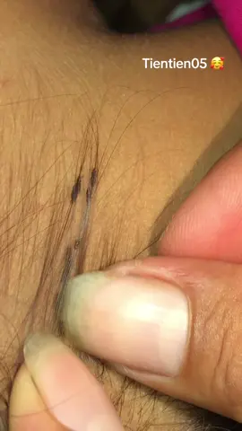 Remove lice #liceo #liceremoval 🥰🥰🥰🥰#omg ❤️❤️❤️❤️