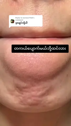 Replying to @warwar1168မြန်မြန်လာမှာလိုက်တော့နော်#ဆားဝက်ခြံပျောက်ခြင်သူများသာဝင်ကြည့်ပါ #က်ခြံပျောက်ခြင်းသူများသာဝင်ကြည့်ပါ #တစ်ပတ်အတွင်းပြောင်းလဲခြင်းမှသုံး #ဆားဝက်ခြံပျောက်ချင်သူများအတွက် #ဝက်ခြံပျောက်ခြင်းမှသုံး 