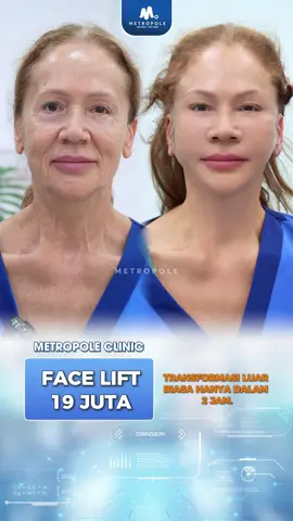 Kerutan di wajah hilang seketika setelah melakukan Facelift 😍🔥  Hubungin kami jika anda ingin tampil muda kembali !  #Metropoleclinic #metropole #rhinoplastyjakarta #operasi #facelift            