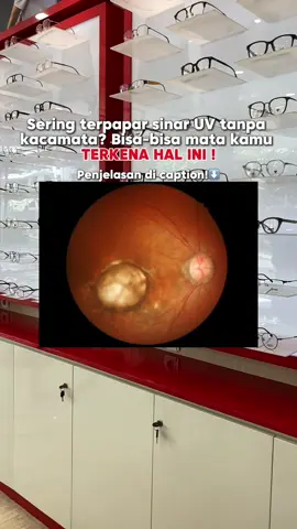 Terkena Degenerasi makula, ini merupakan kerusakan di bagian tengah retina yang bikin penglihatan jadi kabur—khususnya di bagian tengah. Biasanya terjadi seiring usia, tapi paparan sinar UV berlebihan bisa mempercepat kerusakan ini! 📌 Gejala awal: – Pandangan tengah mulai blur – Susah lihat detail (meski pakai kacamata) – Garis lurus keliatan melengkung Jangan tunggu parah! ☀️ Pakai kacamata dengan UV protection 🥦 Makan makanan tinggi antioksidan 🔍 Rutin periksa mata, apalagi kalau udah sering pegal liat layar Sayangi mata kamu dari sekarang, sebelum kehilangan penglihatan perlahan!  #kesehatanmata #penyakitmata #optik #optikinternasionalbandung 