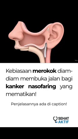 ❓ APA ITU KANKER NASOFARING? Kanker nasofaring adalah kanker yang tumbuh di belakang rongga hidung, tepat di atas tenggorokan (PubMed, 2023). ⚠️ APA AJA GEJALA DARI KANKER NASOFARING? Gejalanya antara lain hidung tersumbat, mimisan berulang, telinga berdenging, gangguan pendengaran, hingga benjolan di leher (NIH, 2023). 🚬 APA PENYEBAB DARI KANKER NASOFARING? Kebiasaan merokok dan paparan asap rokok jadi faktor terbesar yang merusak jaringan nasofaring. Racun dalam asap rokok memicu mutasi sel dan mempercepat pertumbuhan kanker. Selain itu, infeksi virus Epstein-Barr juga berperan (WHO, 2022). 👥 SIAPA AJA YANG RENTAN KENA KANKER NASOFARING? Perokok aktif maupun pasif, orang usia 35 tahun ke atas, serta mereka dengan daya tahan tubuh lemah lebih rentan (Cleveland Clinic, 2023). 👉 Stop merokok hari ini, lindungi hidup Anda dari kanker! 📲 Konsultasi gratis? Hubungi WA 085121332039 atau klik link di bio! #kesehatan #pedulikesehatan  #kankernasofaring #fyp  #sehattubuh    