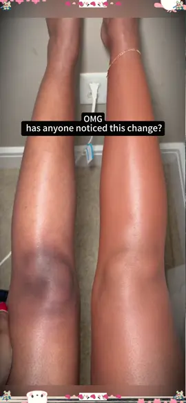 Flawless Skin in Seconds! ✨ Full Coverage Body Makeup That Stays ALL DAY! #UKBeauty#BodyMakeup#FlawlessSkin#MakeupMustHave#WaterproofMakeup#TattooCoverUp#BritishBeauty#FullCoverage#SelfCareUK#BeautyHacks#ForYouDays #TikTokMadeMeBuylt #spotlight #foryou #fyp#viral #trending #tiktokuk