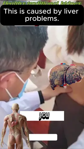 #liver #liverpool #livertransplant #Lifestyle #healthydrink #liverhealth #fentysuperbrandday #healthylife #kidneyfailure #liver 
