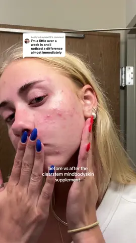 Replying to @Laylabel18 it was painfulllll #collegefinds #acnetreatment #clearstem #acnejourney 