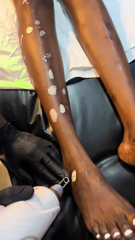 #creatorsearchinsights #scarremoval #acnescartreatment #laserscartreatment #lasertattooremoval 