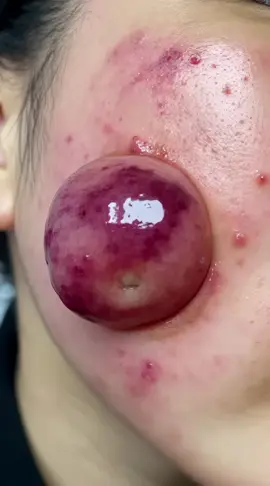Most Disgusting Pimple Pop Ever 🤯💥 (Don’t Watch While Eating! •	#PimplePop #SatisfyingVideo #OddlySatisfying #ViralVideo