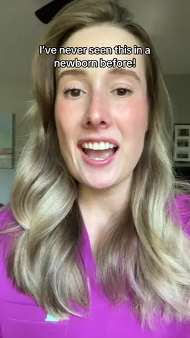 I can’t believe this is so common and I’ve never seen it before: did your baby have any Harlequin Color Change? #newborn #pregnant #momtobe #birth #laboranddelivery 