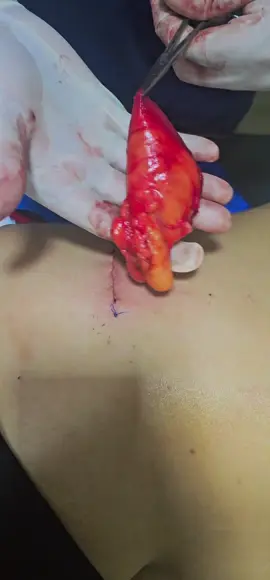 lipoma en espalda #TuMejorOpcion #Portoviejo #drjeffersonsanchez 