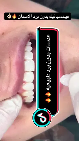 عدسات فيلدسباثيك بدون برد الأسنان لتطويل الاسنان الطبيعية 🔥🔥🔥  #اكسبلور #ترند #قشور_خزفية_هوليوود_سمايل_تجميل_اسنان🦷 #دكتورتاجو #تجميل_الأسنان 