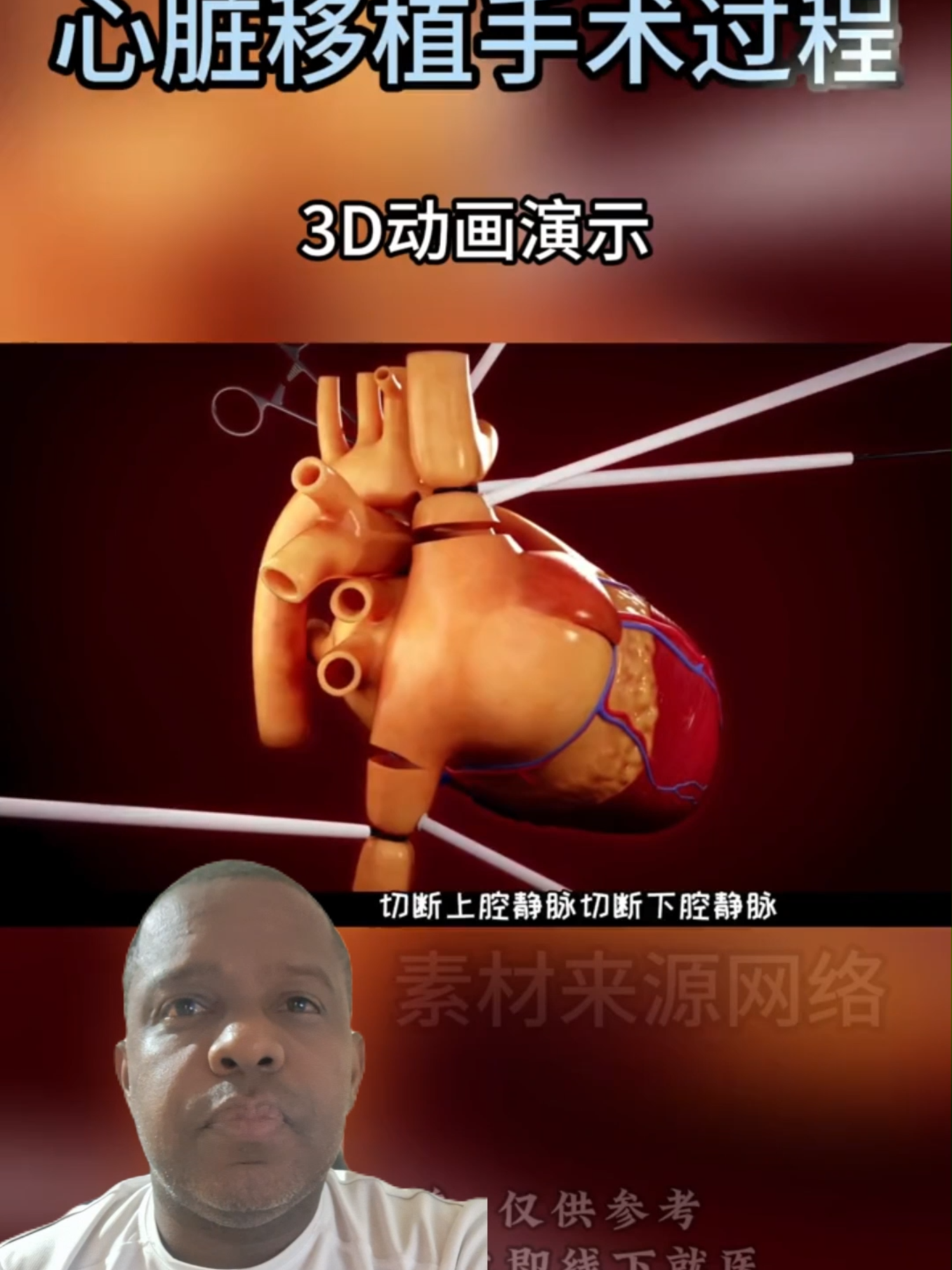 Transplante de coração em 3D como e feito #transplante de coração #trnasplante em 3d Siga nosso canal para mais videos .. @videos.engraçados339