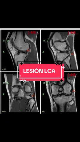 De estar a punto de jugar en Estados Unidos 🇺🇸 a quedar en muletas 😢⚽️… Soy Simón, me acaban de operar de LCA y quiero documentar y compartir  este proceso para quien le pueda servir . Acompáñenme en este camino 🙌 #futbolistas #lesion #LCA #motivacion #storytime 
