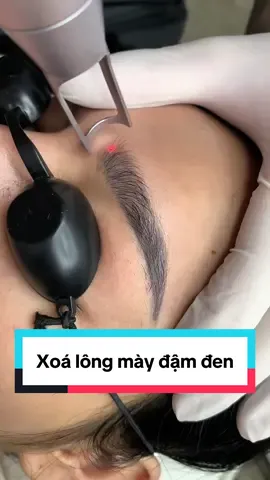 Xoá lông mày đậm đen.