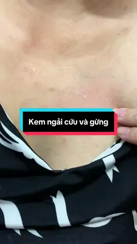 Càng gãi là càng ngứa , bôi lớp kem ngải cứu lên là dịu ngay #kemngaicuuvagung #kemboingoaida #kemtringua #lethao_3106 