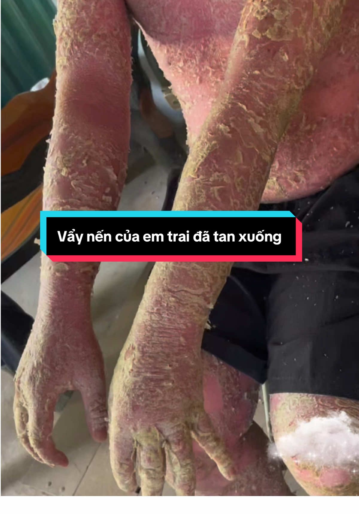 Vẩy nến của em trai đã xuống #vaynen #viemdacodia @Thị tuyến dc 35 