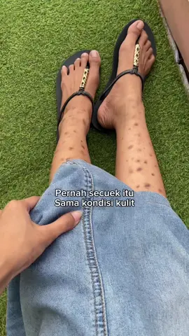 Kalian juga pernah gak sih secuek ini sama diri sendiri😩 #darahmanis #bekasluka #bodycare #gigitannyamuk #bekascacar 